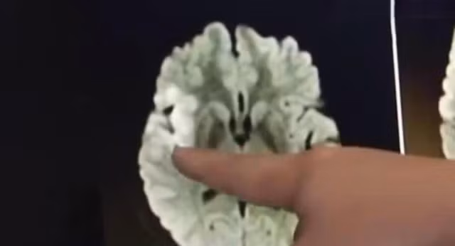 om dien thoai suot 20 gio lien mot nguoi phu nu bi tac mach mau nao