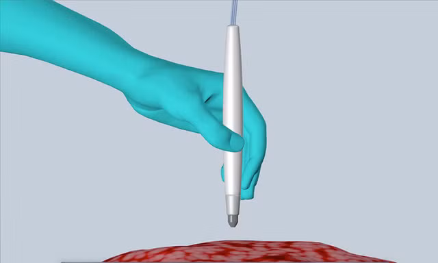 chiec but phat hien ung thu trong 10 giay