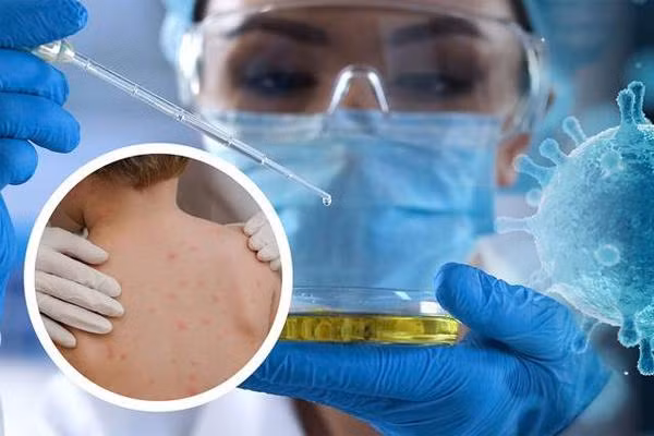 Bệnh đậu mùa khỉ: Đường lây truyền và cách phòng ngừa cần làm ngay