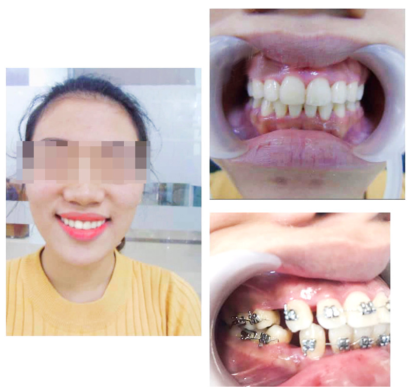 Nhiều bố mẹ “hối tiếc” vì để lỡ giai đoạn vàng niềng răng cho con