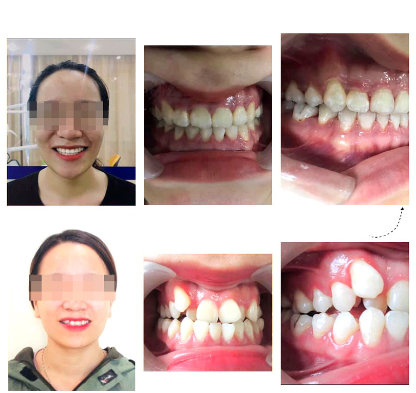 Nhiều bố mẹ “hối tiếc” vì để lỡ giai đoạn vàng niềng răng cho con