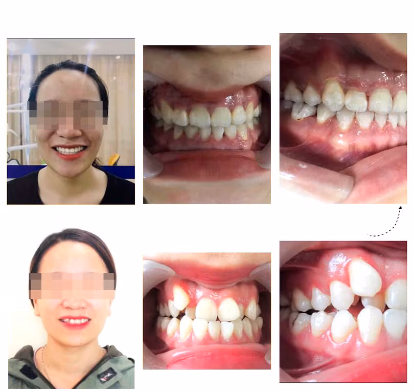 Nhiều bố mẹ “hối tiếc” vì để lỡ giai đoạn vàng niềng răng cho con