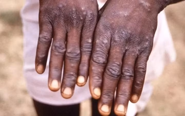 Các nước “đổ xô” tích trữ vaccine đậu mùa khỉ