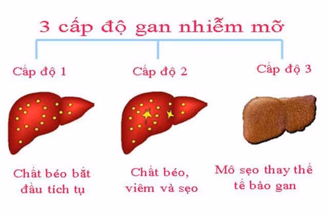 Bệnh gan nhiễm mỡ do rượu là gì?