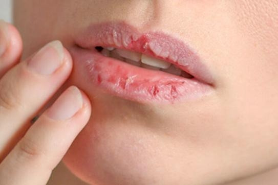photo-1701947514833 Làm thế nào để thoát khỏi môi nứt nẻ trong mùa đông?