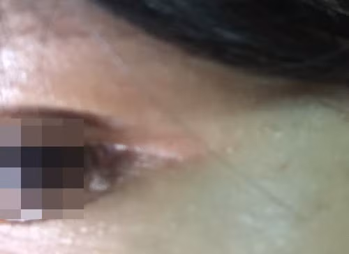 Mụn thịt mọc càng nhiều là do biết “nhảy”?