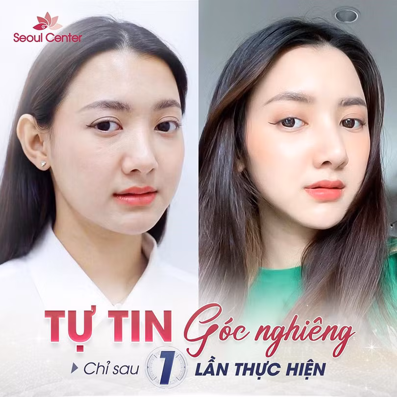 Phẫu thuật nâng mũi sụn nhân tạo giữ được bao lâu?