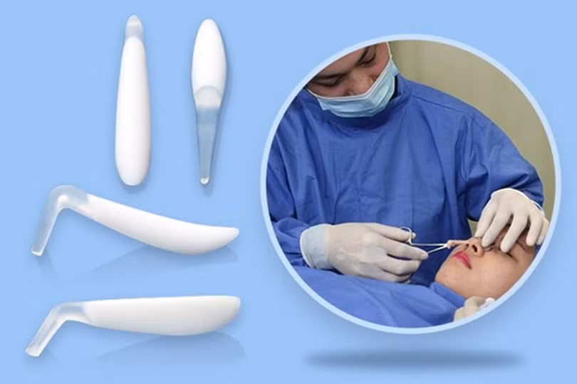 Phẫu thuật nâng mũi sụn nhân tạo giữ được bao lâu?