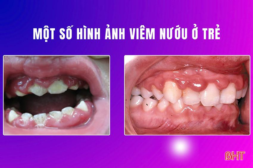 Một số hình ảnh viêm nướu ở trẻ viem nướu 1.jpg