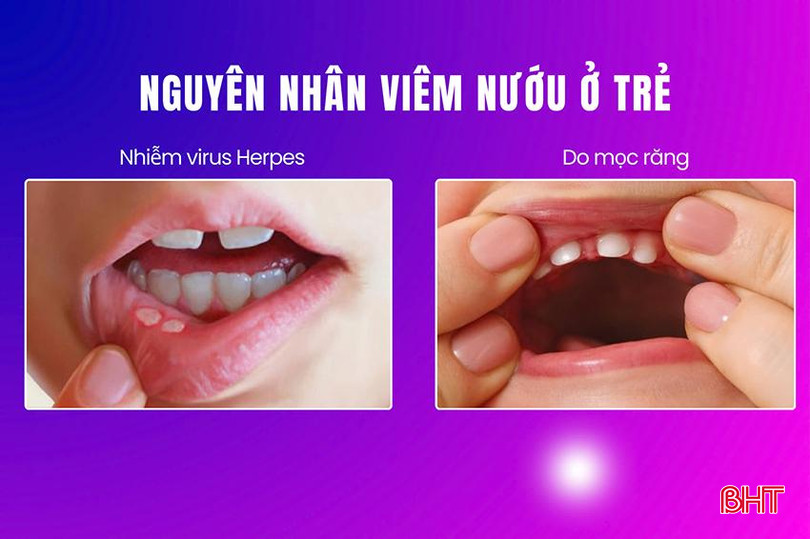 Nguyên nhân gây viêm nướu ở trẻ. viem nướu 2.jpg