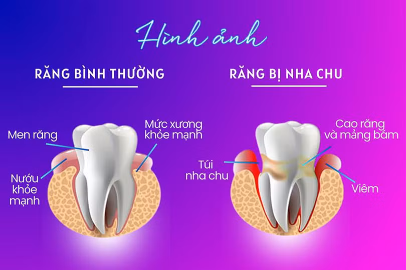 Khác biệt giữa răng bình thường và răng bị nha chu.