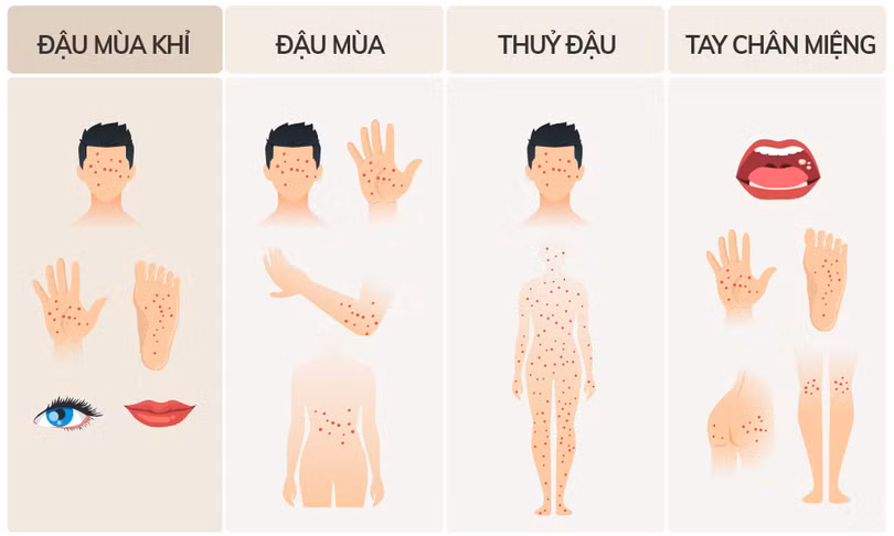 Ca đậu mùa khỉ thứ hai ở Việt Nam