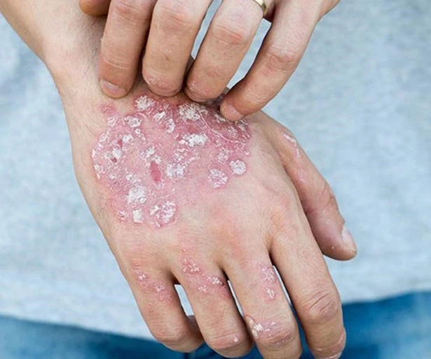 Hiểu rõ bệnh vảy nến để điều trị đúng phương pháp