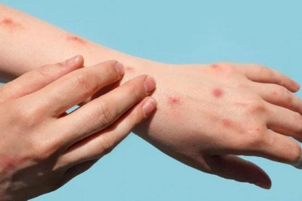 Đậu mùa khỉ có thể lây truyền trước khi các triệu chứng xuất hiện
