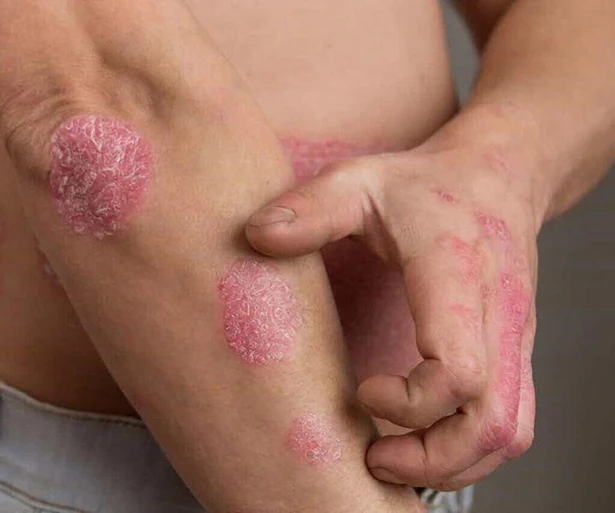 Hiểu rõ bệnh vảy nến để điều trị đúng phương pháp