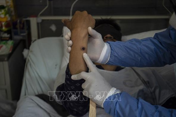 Bệnh đậu mùa khỉ vẫn là tình trạng khẩn cấp về sức khỏe cộng đồng toàn cầu