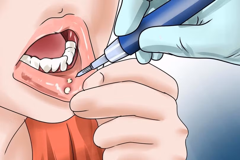 Trị nhiệt miệng ở trẻ nhỏ