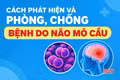 [Infographic] Cách phát hiện và phòng, chống bệnh do não mô cầu