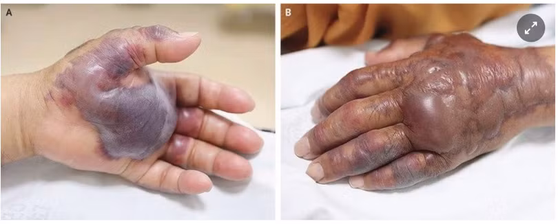 Loại vi khuẩn ăn thịt người đang lây lan tại Mỹ