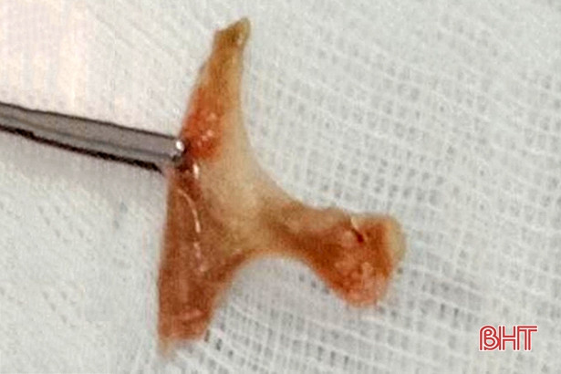 Gắp mảnh xương vịt 3 cm trong thực quản bệnh nhân ở Nghi Xuân