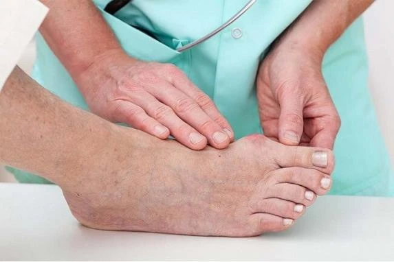 Nguyên nhân gây bệnh gout và độ tuổi dễ mắc