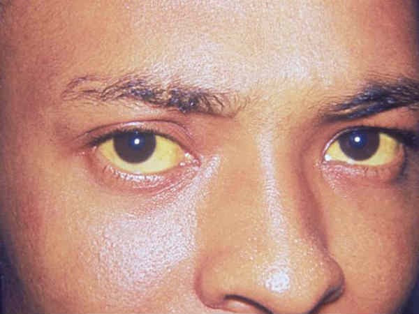 7 vấn đề sức khỏe mùa nắng nóng và cách phòng chống hình 6 7 vấn đề sức khỏe mùa nắng nóng và cách phòng chống