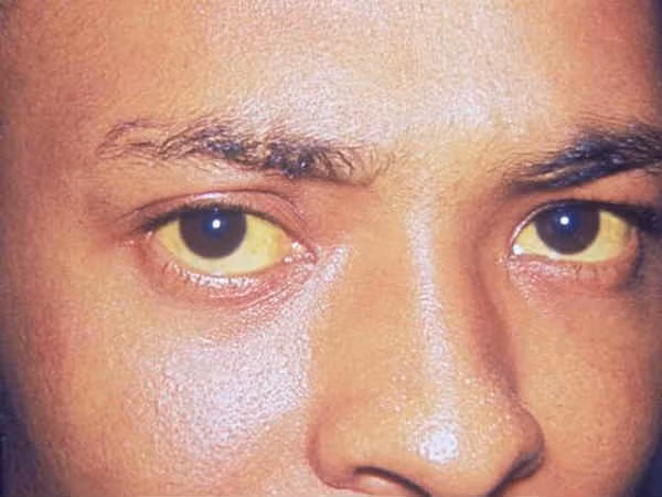 7 vấn đề sức khỏe mùa nắng nóng và cách phòng chống