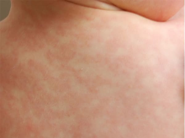 7 vấn đề sức khỏe mùa nắng nóng và cách phòng chống hình 5 7 vấn đề sức khỏe mùa nắng nóng và cách phòng chống