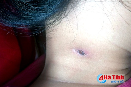 Cảnh giác với sốt mò - căn bệnh hiếm gặp có thể tử vong ảnh 1