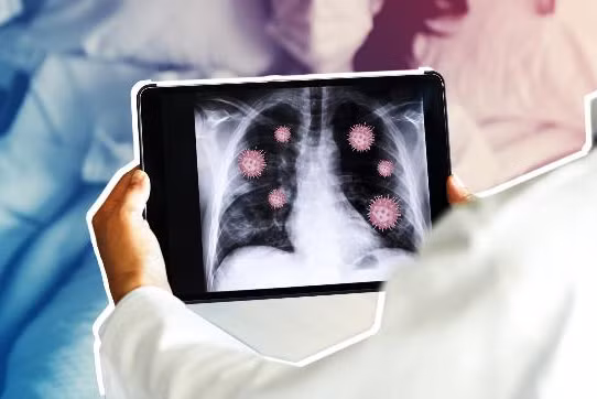 Viêm phổi do COVID-19, triệu chứng và những điều cần biết