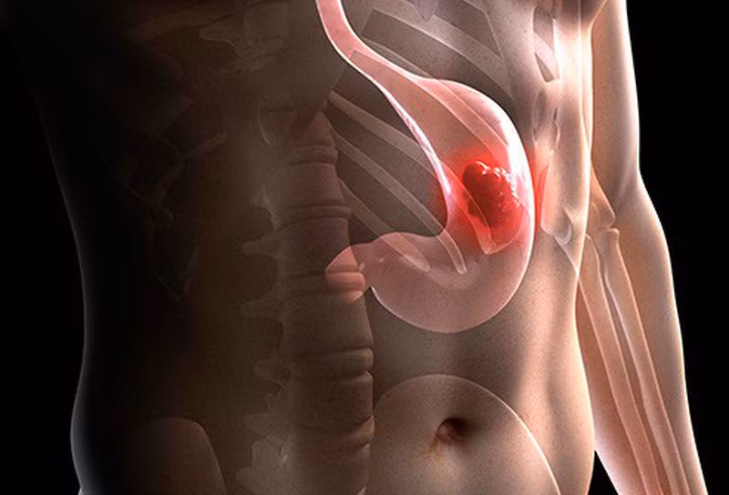 Những yếu tố nguy cơ cao gây ung thư dạ dày