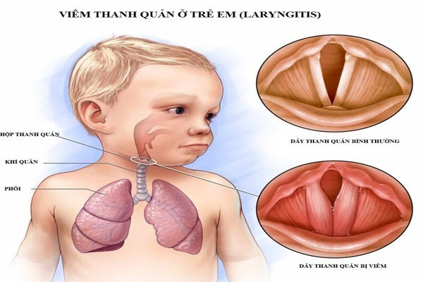 Viêm thanh quản cấp ở trẻ mùa lạnh, dấu hiệu cần nhập viện ngay