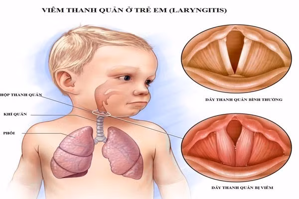 Viêm thanh quản cấp ở trẻ mùa lạnh, dấu hiệu cần nhập viện ngay