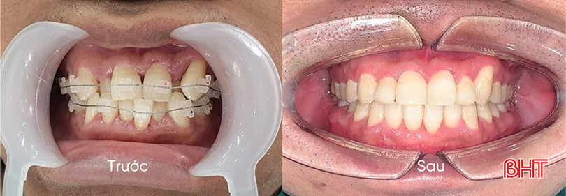 Răng được nắn chỉnh về lại đúng hướng, đúng vị trí bằng phương pháp niềng răng. 39313ffd389199cfc080.jpg