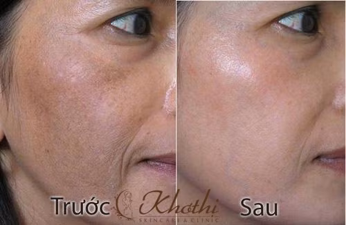 Hiệu quả rõ rệt của công nghệ Silic tảo sống chỉ sau một tuần điều trị.