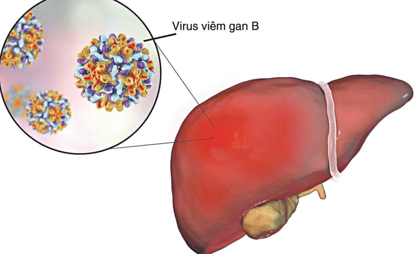 Các virus viêm gan A, B, C có thể gây tổn thương gan cấp tính