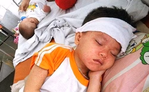 Giai đoạn mọc ban kéo dài 4 - 6 ngày