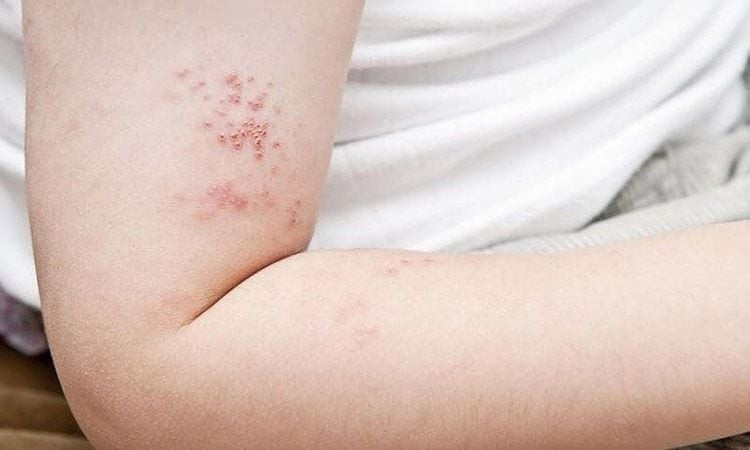 Bệnh zona thần kinh là một bệnh truyền nhiễm, có thể lây lan Bệnh zona thần kinh là một bệnh truyền nhiễm, có thể lây lan
