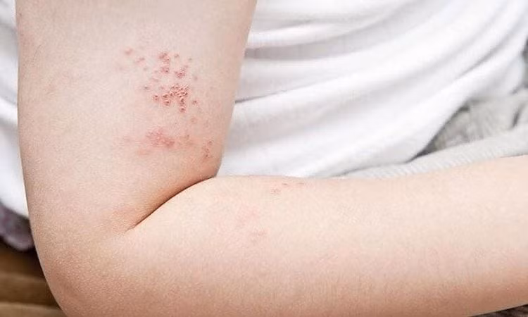 Bệnh zona thần kinh là một bệnh truyền nhiễm, có thể lây lan