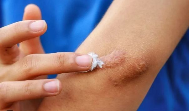Bộ Y tế đình chỉ, thu hồi toàn quốc, yêu cầu tiêu huỷ 1 loại gel ngừa sẹo do vi phạm 3 lỗi (ảnh minh hoạ) Bộ Y tế đình chỉ, thu hồi toàn quốc, yêu cầu tiêu huỷ 1 loại gel ngừa sẹo do vi phạm 3 lỗi (ảnh minh hoạ)