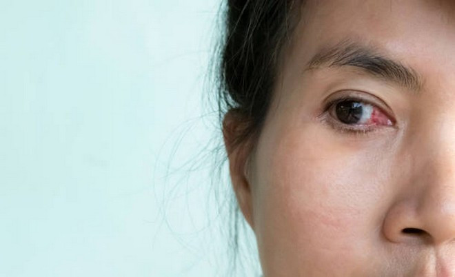 Đeo kính áp tròng quá lâu có thể gây viêm giác mạc. (Ảnh: iStock) Đeo kính áp tròng quá lâu có thể gây viêm giác mạc. (Ảnh: iStock)