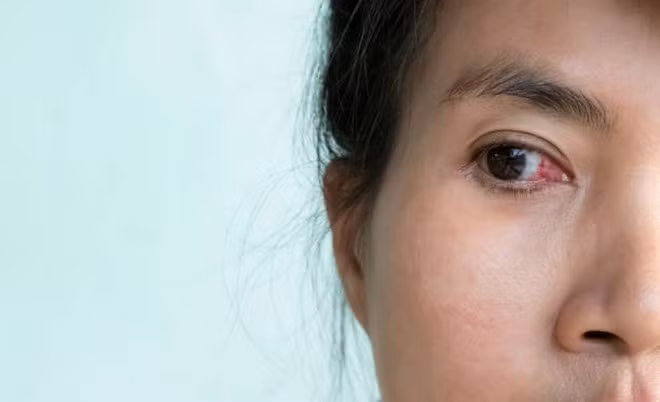 Đeo kính áp tròng quá lâu có thể gây viêm giác mạc. (Ảnh: iStock)