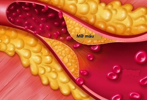 Mỡ máu cao còn được ví như "sát thủ thầm lặng" có thể gây viêm tụy, nhồi máu cơ tim, đột quỵ... Mỡ máu cao còn được ví như "sát thủ thầm lặng" có thể gây viêm tụy, nhồi máu cơ tim, đột quỵ...
