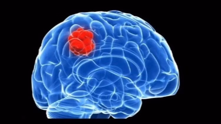 Động kinh là dấu hiệu đầu tiên gợi ý bệnh u não.