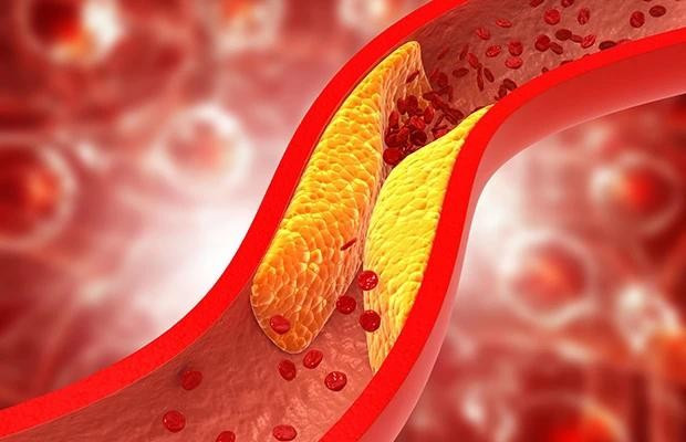Mỡ máu xấu (cholesterol xấu) có thể dẫn đến đau tim, đột quỵ. Mỡ máu xấu (cholesterol xấu) có thể dẫn đến đau tim, đột quỵ.