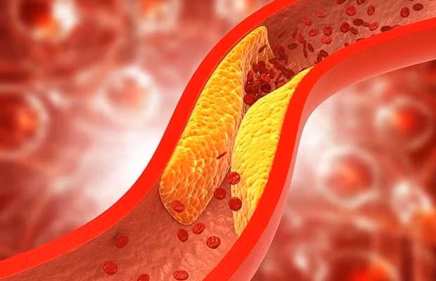 Mỡ máu xấu (cholesterol xấu) có thể dẫn đến đau tim, đột quỵ.