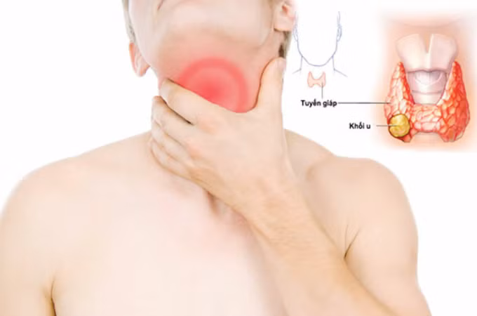 Ung thư tuyến giáp có tiên lượng tốt nếu được phát hiện sớm và điều trị kịp thời. Ảnh minh họa do bệnh viện cung cấp