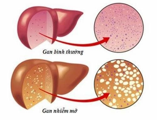 Gan nhiễm mỡ gồm có hai loại: gan nhiễm mỡ không do rượu và do rượu Gan nhiễm mỡ gồm có hai loại: gan nhiễm mỡ không do rượu và do rượu