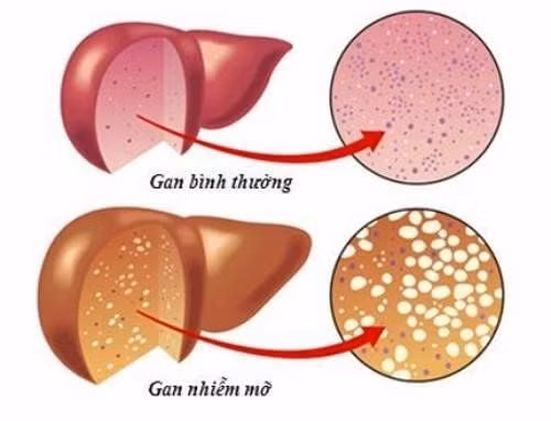 Gan nhiễm mỡ gồm có hai loại: gan nhiễm mỡ không do rượu và do rượu