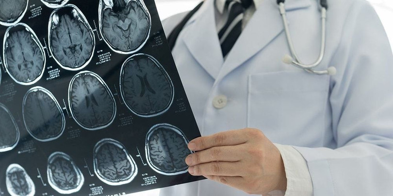 CT-scanner sọ não có thể giúp bác sĩ chẩn đoán đột quỵ CT-scanner sọ não có thể giúp bác sĩ chẩn đoán đột quỵ